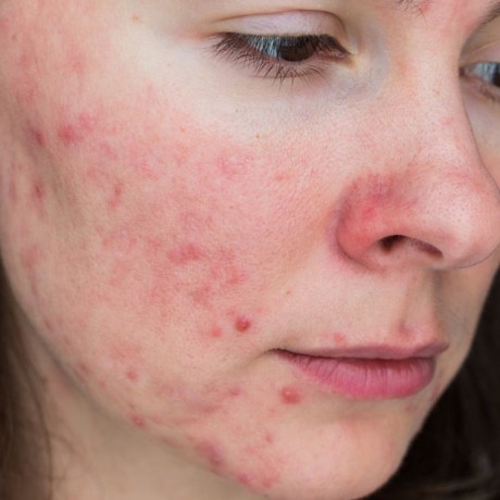 Rosacée : causes, symptômes et traitements de l'acné rosacée