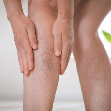 Phlébite : causes, symptômes et traitements